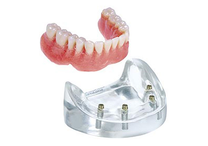 salvatierra dentaduras retenidas por implantes
